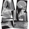 Broken Bones X-Rays
