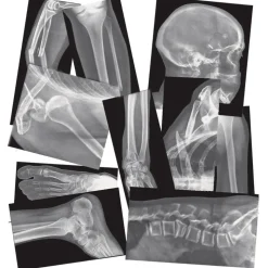 Broken Bones X-Rays