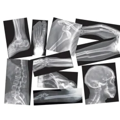Broken Bones X-Rays