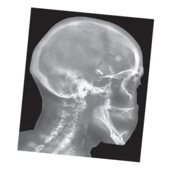 Broken Bones X-Rays