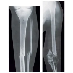 Broken Bones X-Rays