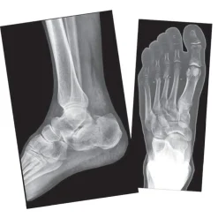 Broken Bones X-Rays